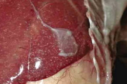 Які патоморфологічні зміни супроводжують кампілобактеріоз